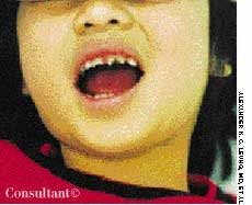 Nonsyphilitic Dental Dysplasia