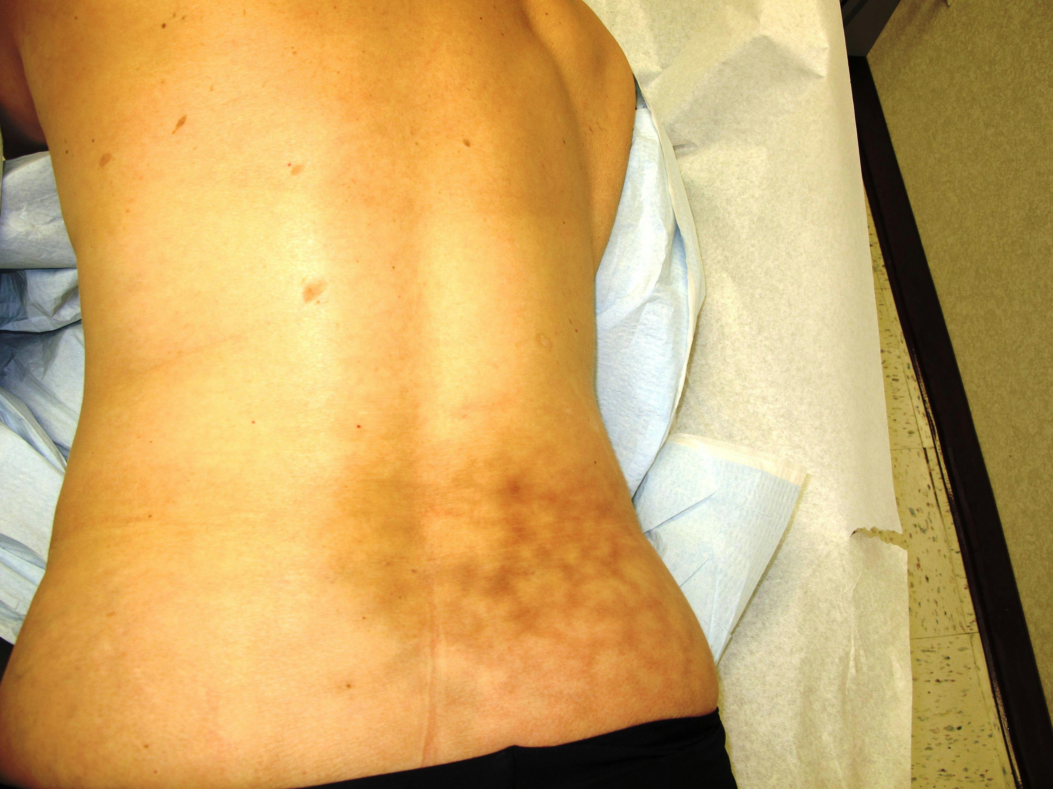 An Asymptomatic Rash on the Low Back of an Older Woman 