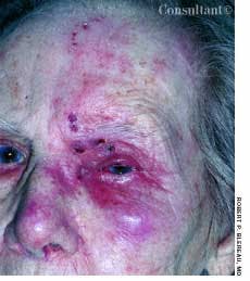 Ophthalmic Zoster:  Common Manifestation in the Elderly 