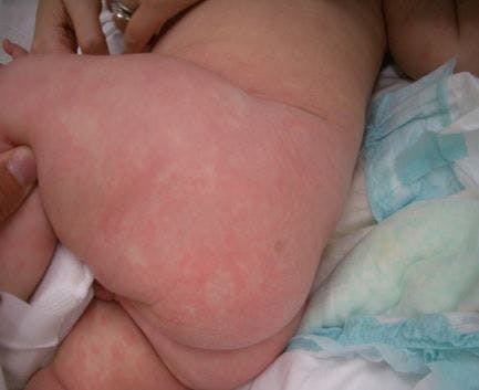 Kawasaki disease in a 7-month-old boy 