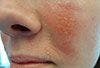 Acute Contact Dermatitis