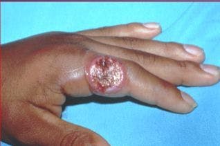 Digital Quiz: 8 Questions About Finger Ulcers