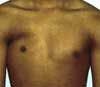 Congenital Partial Absence of the Pectoralis Major Muscle