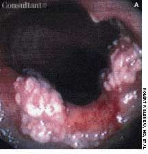 Solitary Rectal Ulcer Syndrome