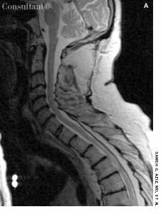 Spinal Epidural Lipomatosis