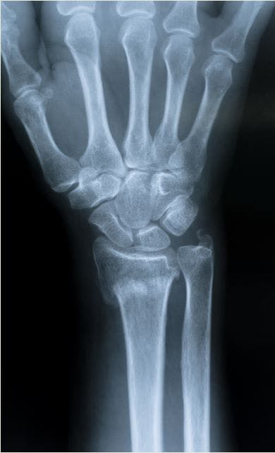 Older Men Need More Aggressive Osteoporosis Screening