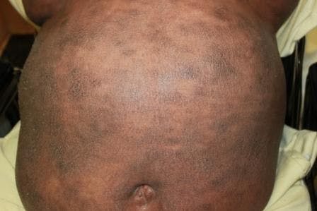 Erythroderma in a 60-Year-Old Man: What Cause?