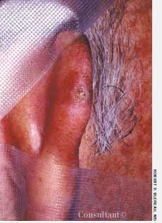 Squamous Cell Carcinoma on the Ear