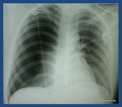 Pleuritic Chest Pain in a 23-year-old Woman