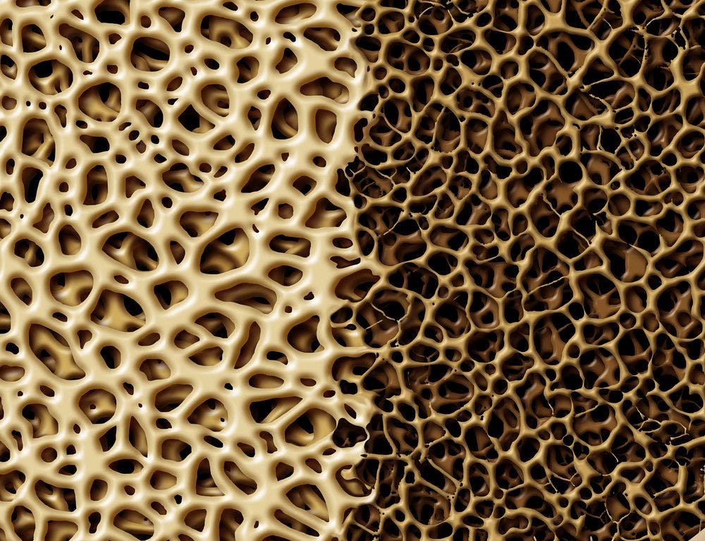 Abolaparatide Increases Bone Microarchitecture and Strength in Women with Osteoporosis