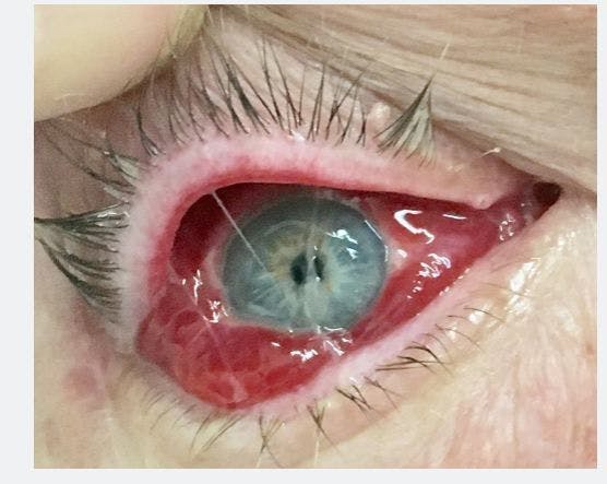 Severe Ocular Symptoms Caused by Succulent Sap 