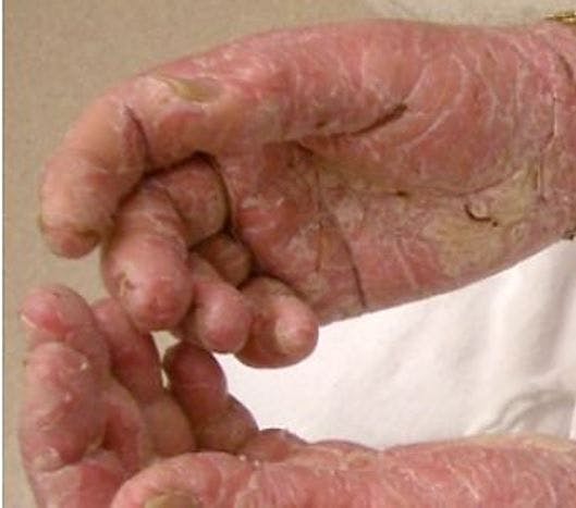 rash caused by nevirapine