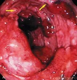 Ulcerative Colitis With Pseudopolyps