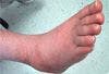 Go For the Glory Quiz: MS, Charcot Foot, Rx Errors, Sores, Obesity and Exercise