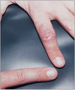 Mycobacterium marinum Infection in a 33-Year-Old Man