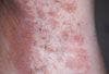 Can you identify this axillary rash?