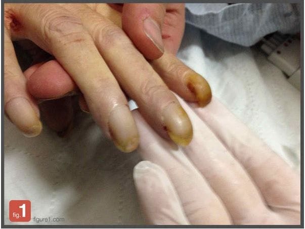 Fingernail clubbing, lung cancer 