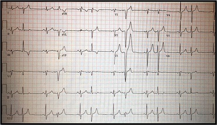 ECG Challenge: Palpitations & Insomnia in Middle Age 