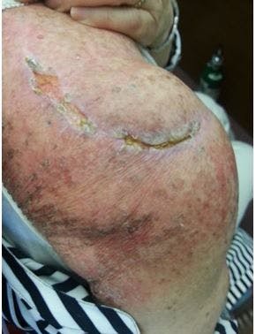 post-radiation dermatitis 