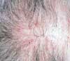 Lichen Planopilaris With Abrupt Onset of Rapid Hair Loss