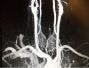 Vertigo After a Car Accident: Vertebral Artery Dissection?