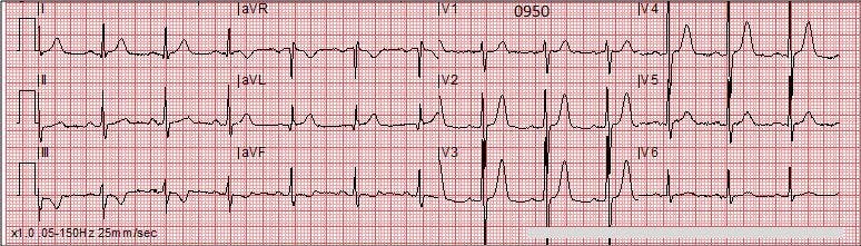 Chest Pain in an Adult Male With an Ominous ECG 